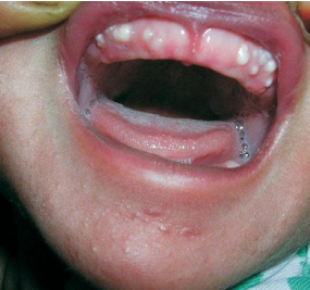 <p>A full term newborn boy, weighing 3 kg, born out of an uncomplicated pregnancy, was brought to us for evaluation of a few small, white and round bumps on the gingival surface. Examination of the oral cavity showed multiple, firm, pearly-white papules measuring 2 to 4 mm in diameter, grouped over the vestibular aspect of the alveolar ridge of the maxillary arch</p>