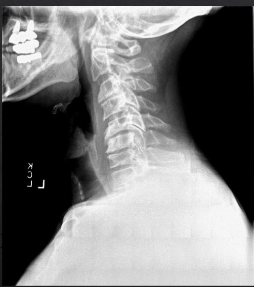 <p>Is this film of diagnostic quality (Lateral Cervical)</p>