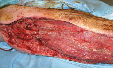 <ul><li><p>“Flesh-eating” disease </p></li><li><p>Exotoxin A produced by S. pyogenes acts as a superantigen</p></li></ul><p></p>