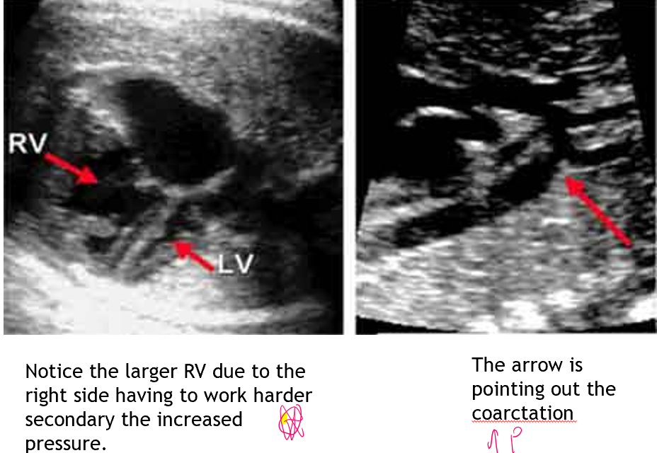 <p>normally blood flows from right to left </p><p>narrowing of ao isthmus causes resistance for LV output</p><ul><li><p>LV afterload increases and output decreases</p></li></ul><p>distal to the narrowing may have lower pressure now than pulm art</p><ul><li><p>RV output increases and pressure loaded </p></li></ul><p>therefore blood may now go from ao to pa </p>