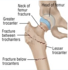 <p>More common in older adults/geriatrics with osteoporosis or avascular necrosis, Both lead to weakening or collapse of weight bearing joints, fractures occur with minimum trauma</p>
