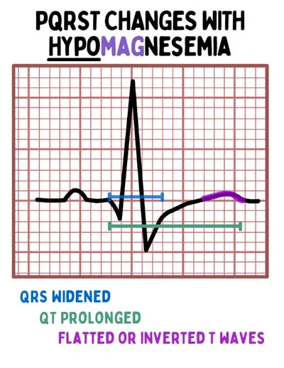 <p>Identify the electrolyte imbalance based on the ECG: </p><ul><li><p>Tall T wave</p></li><li><p>ST depressed</p></li><li><p>Prolonged QT interval</p></li></ul><p></p>