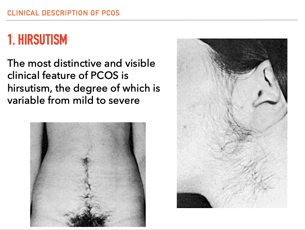 <ul><li><p>The most distinctive and visible clinical feature of PCOS is hirsutism, the degree of which is variable from mild to severe </p></li></ul><p></p>