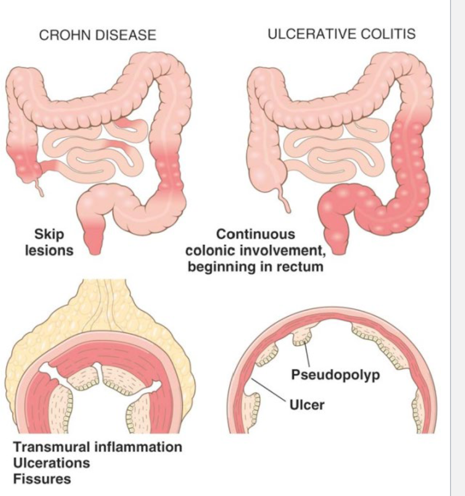 <p>Two Types: </p><ul><li><p>Crohn Disease </p></li></ul><ul><li><p>Ulcerative Colitis</p></li></ul><p></p>
