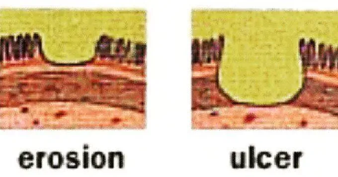 <p>An sequelae (outcome of necrosis):</p><p><span><strong>Erosion and Ulceration</strong></span></p><p>These occur when necrotic tissue is located on <span><strong>epithelial surfaces</strong></span>.</p><p>The<span><strong> dead cells may lose their attachmen</strong></span>t to the underlying living tissue and <span><strong>desquamate (or slough)</strong></span> into the surrounding space or lumen, causing either ulceration or erosion. </p><p><span><strong>Erosion</strong></span> implies loss of epithelial cells only.</p><p>While <span><strong>ulceration</strong></span> occurs when the basement membrane is involved and the underlying connective tissue is exposed.</p>