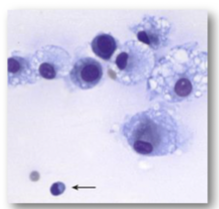 <p>This is synovial fluid from a canine stifle.</p><ul><li><p>What are these cells?</p></li><li><p>Is this cytology consistent with normal, inflammatory or noninflammatory joint disease?</p></li><li><p>Name a common joint disease that is consistent with this cytology?</p></li></ul><p></p>