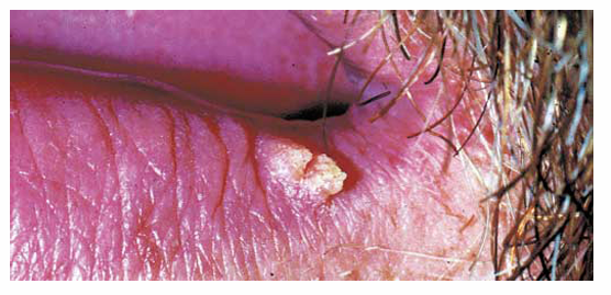 <p>1.what is this lesion?</p><p>2. how to treat/ manage it?</p><p>3. classification of oral lesion in HIV?</p>