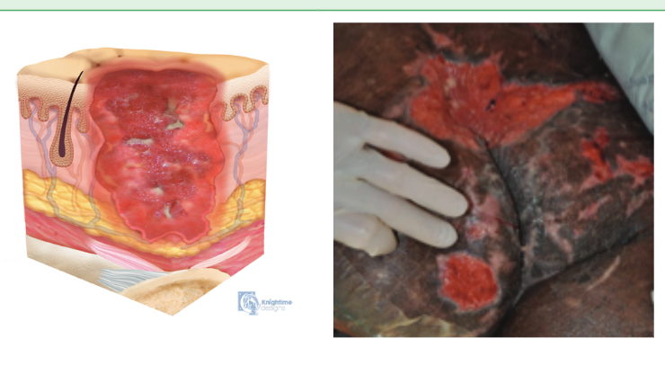 <p>Full-thickness skin loss with <em>exposed SubQ tissue (adipose)</em></p><ul><li><p>Granulation tissue and epibole are present</p></li><li><p>Depth varies by location</p></li><li><p>Fascia, muscle, tendon ligament, cartilage, bone NOT exposed</p></li></ul><p></p>
