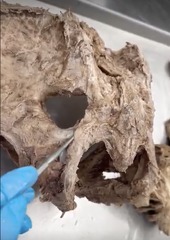 <p>Name the ligament</p>