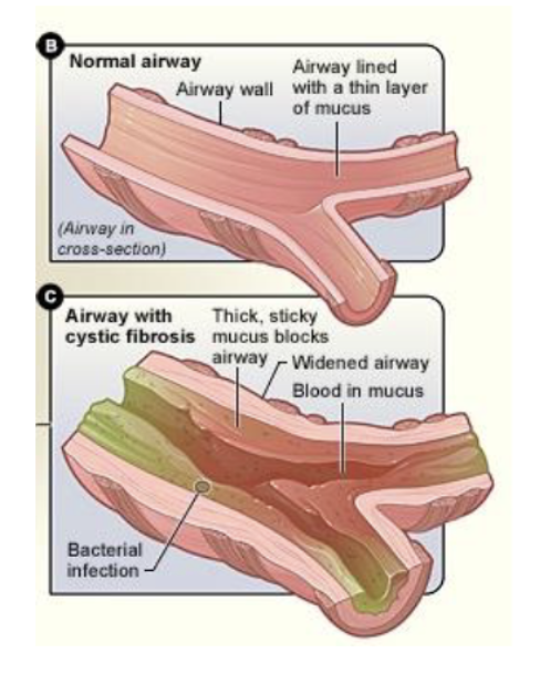 <p>The <strong>CFTR protein </strong>usually modulates flow of water and chloride out of cells into secretions</p><p></p><p>Mutations lead to:</p><ul><li><p>Inefficient pumping causing <strong>THICK</strong> <strong>secretions</strong></p></li><li><p>Thick mucus builds up in airway leading to <strong>chronic infection/inflammation</strong></p></li></ul><p></p>