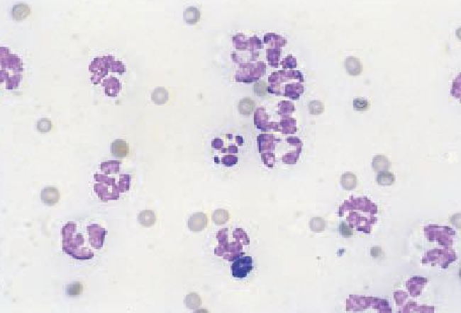 <ul><li><p>Large number of neutrophils </p></li><li><p>less than 85% of total nucleated cells </p></li></ul><p></p>
