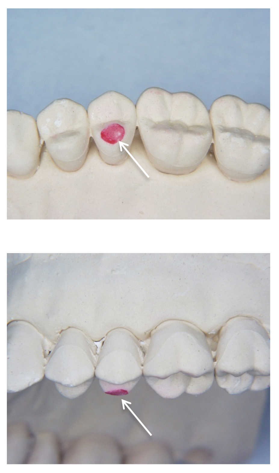 <p>The lab may have had to do some adjustments to the occlusion on the opposing arch to achieve enough occlusal clearance</p>