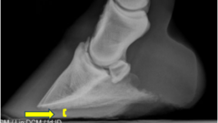 <p>What is the etiology for subsolar bruising?</p>