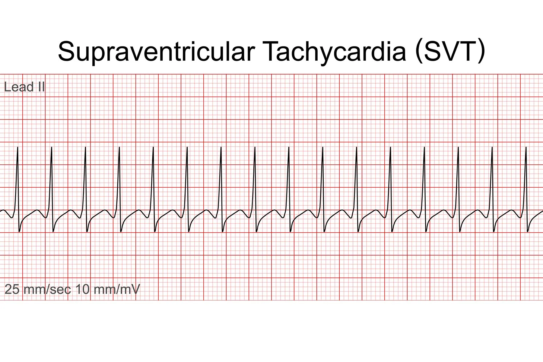 <p><span>cannot identify p wave and narrow QRS. rapid heartbeat that develops when the normal electrical impulses of the heart are disrupted.</span></p>