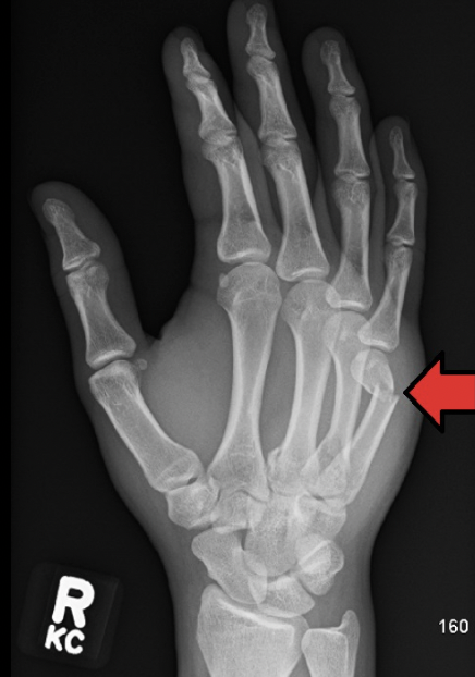 <p>A boxer's fracture is <mark>a break in the neck of the 5th metacarpal</mark></p><p></p>