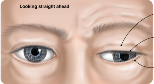 <ul><li><p>Ptosis</p></li><li><p>Strabismus - eye pulled inferolaterally (down and out appearance)</p></li><li><p>Mydriasis (abnormal dilation of pupil)</p></li><li><p>Limited range of movement: unable to move up, down, or inward towards the nose</p></li></ul><p></p>