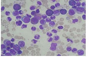 <p>Leukemia </p>