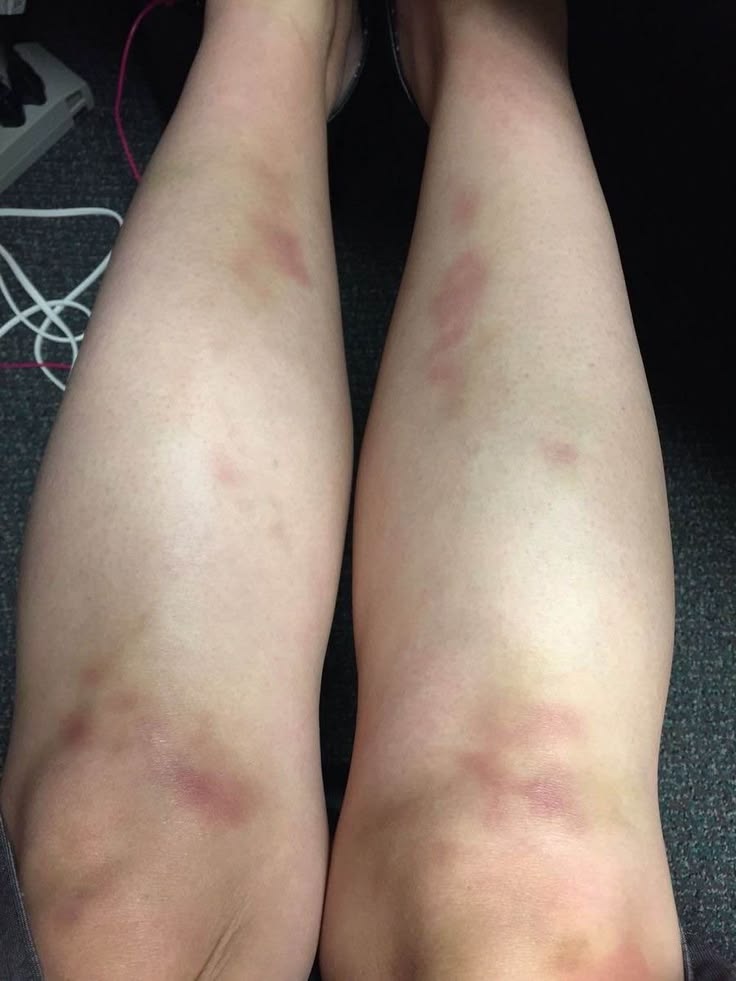 <p>a dark mark on the skin caused by an injury</p><p></p><p><strong>Common collocations</strong></p><ul><li><p>have a ___</p></li></ul><p></p><p><em>I've got a ____ on my arm.</em></p><p><em>The fall left a large ____.</em></p>