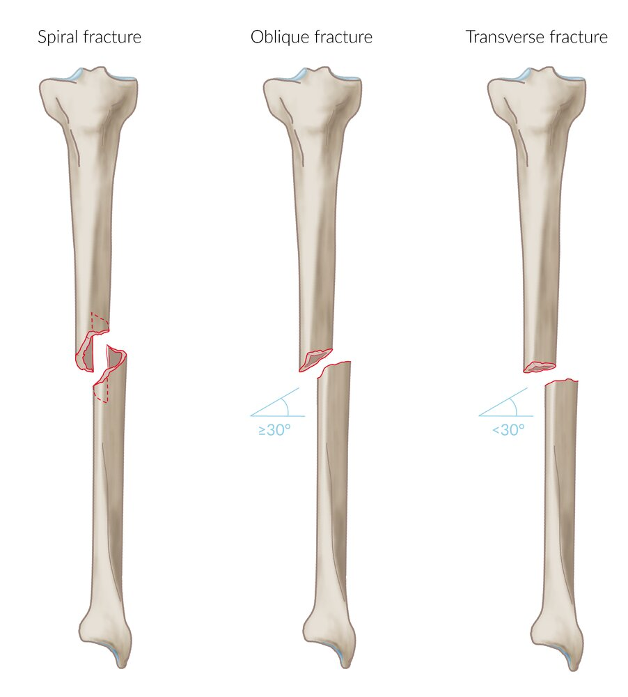<p>Transverse: Perpendicular (horizontal) fracture line</p><p>Oblique: Diagonal fracture line</p><p>Spiral: Twisted fracture line (corkscrew shape)</p>
