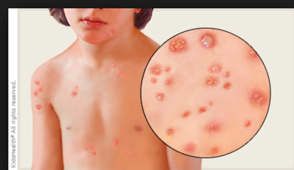 <p>Causative Agent: Human Herpesvirus 3 (HHV-3) (Varicella-zoster virus); Highly contagious</p><p>Symptoms/Signs: 10-20 Day incubation; Fever, Abundant rash on scalp, face, trunk, and extremities; Skin lesions progress to papules containing clear fluid which encrust and fall off.</p>