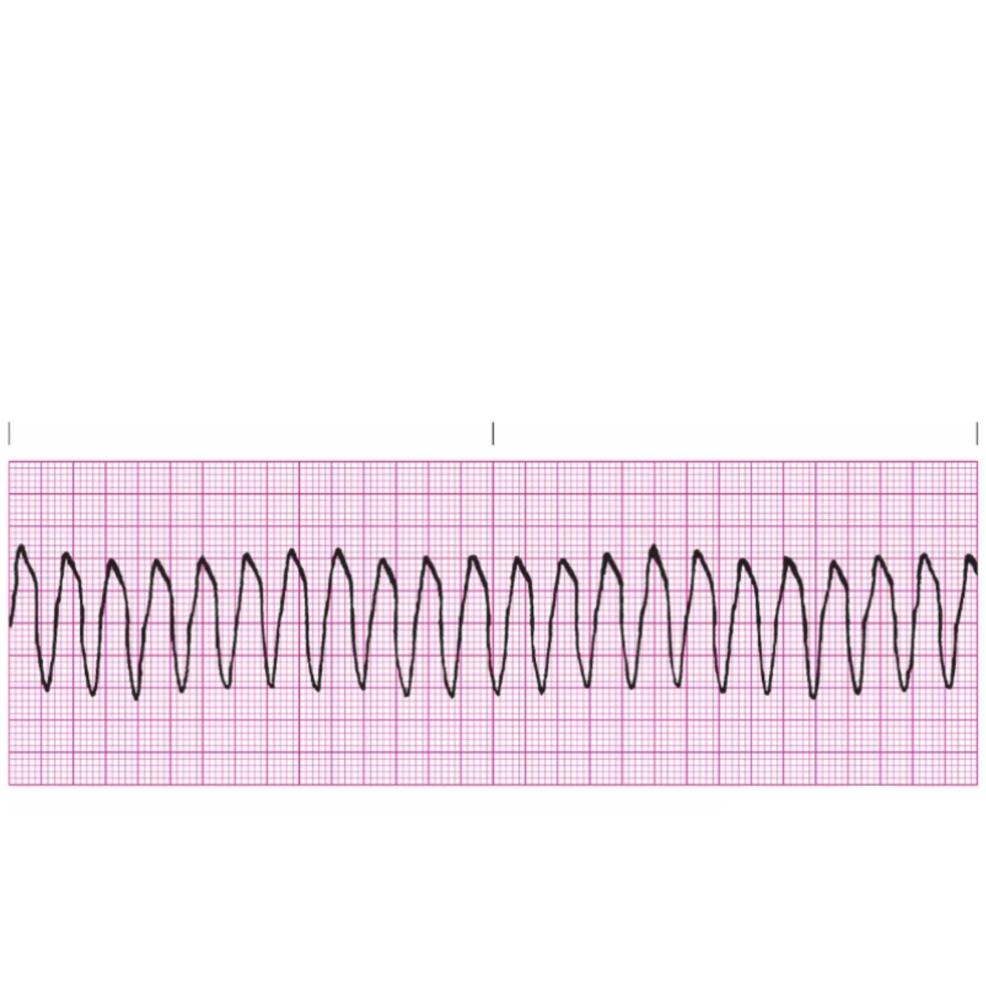 <p class="is-empty is-editor-empty has-focus">Rules for Ventricular Tachycardia includes </p>