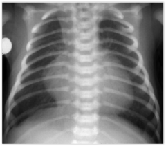 <p>Eval: </p><p>Echo</p><p>CXR triad: </p><p>- "egg on string" (in image)</p><p>- increase pulm vasc congestion</p><p>- cardiomegaly</p><p>Tx: </p><p>PGE1(prostaglandins): to allow PDA, which allows for mixture of systemic and pulmonary blood</p><p>Surgery</p>