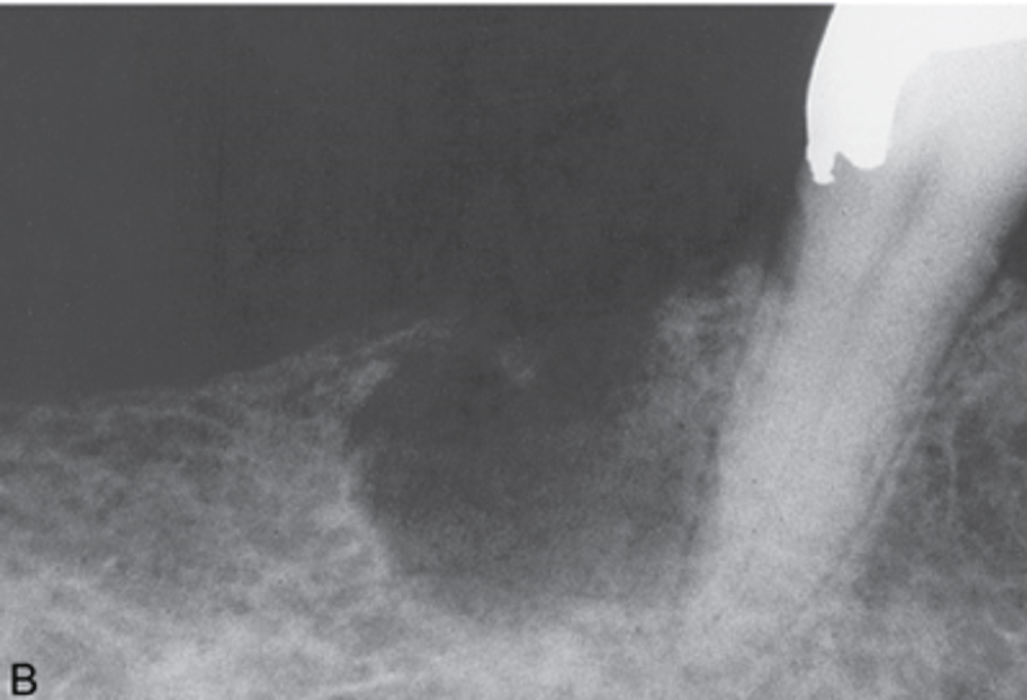 <p><br>-composed of odontogenic epithelium that contains "ghost cells"</p><p>-also referred to as gorlin cyst</p><p>-most commonly seen individuals younger than 40 years</p><p>-lesions occur equally in the maxilla and mandible, most often in the incisor and cuspid area</p><p>-present as well defined unilocular or multilocular radiolucency</p>