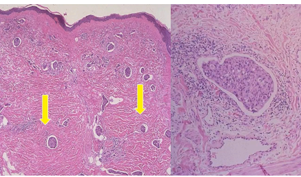 <p>Usually seen in inflammatory carcinoma. Identify the pathology</p>