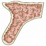 <p><span>Composed of a thin layer of cortical bone surrounded by a core of low density trabecular bone of poor strength, requires the longest time to integrate – </span><span style="color: rgb(255, 0, 0);">8 months</span></p>