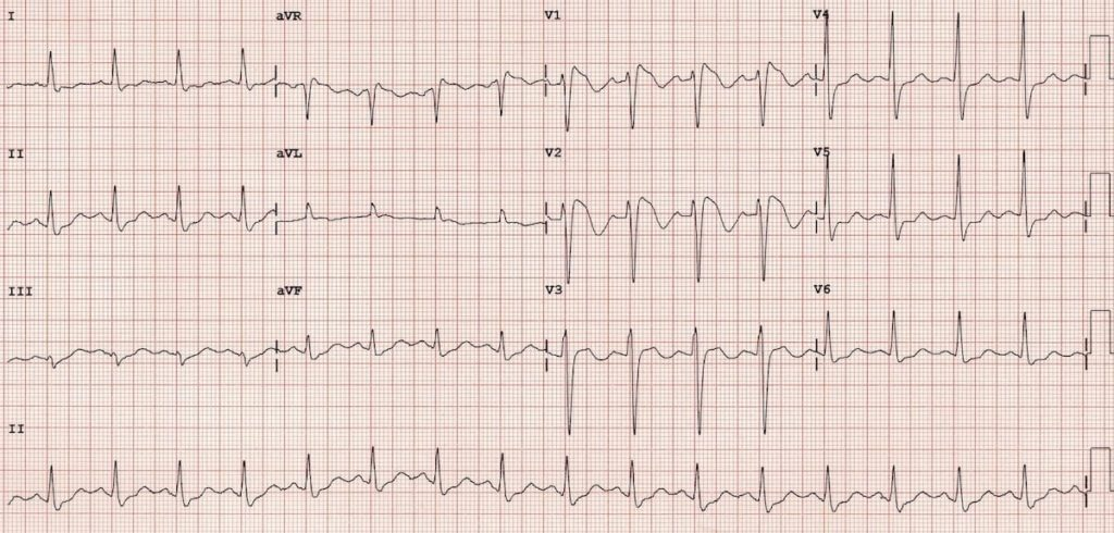 <p>Delay in depolarization of RV, which can occur in a healthy heart </p><p>-See terminal R wave in V1/V2 with discordant ST/T waves, broad S waves in V5/V6</p>