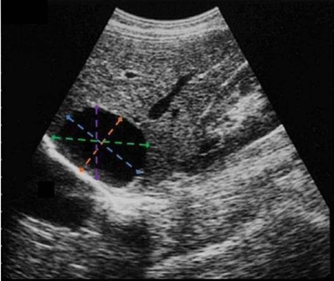 <p>Which line indicates the correct AP measurement of the liver cyst </p>