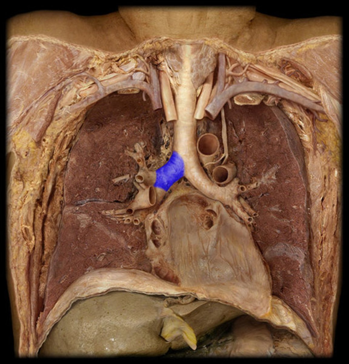 <p>-wider, shorter, more open, and more vertical than the left primary bronchus</p><p>-easier for foriegn material to enter</p>