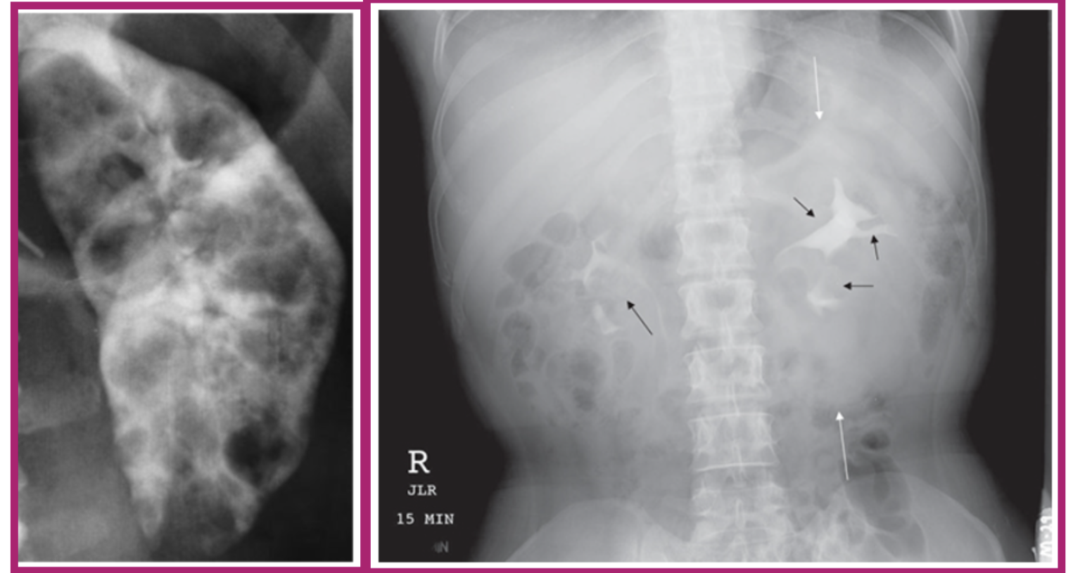 <p>what pathology does this image show</p>