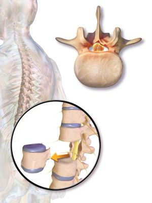 <p>Vertebral Body Removal</p>
