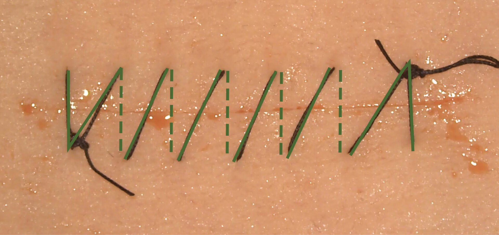 <p>A continuous suturing method that involves only two knots—one at the beginning and one at the end.</p><ul><li><p><span>This technique is often used for long wounds and can provide even tension distribution across the repair</span></p></li></ul><p></p>