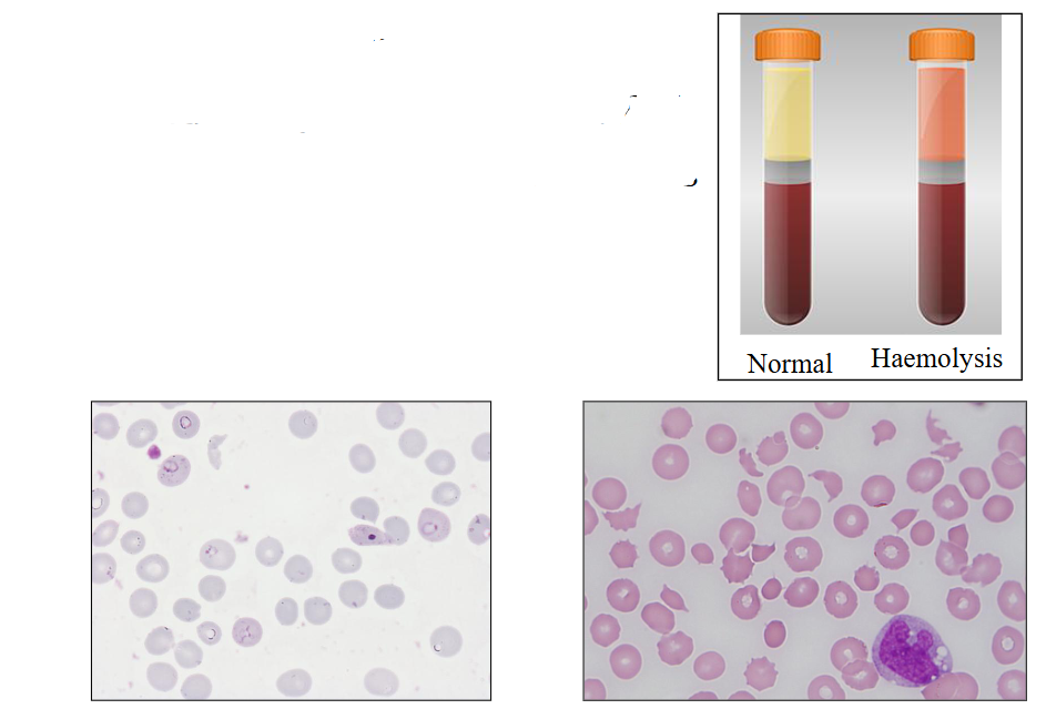 <p>- Red cell lysis occurs inside BV (blood vessel)</p><p>- Blood film: fragmented red cells</p><p>- Haptoglobin low</p><p>- Plasma Hb</p><p>- Haemosiderin in urine</p><p>.</p><p>- plasma looks red because there is Hb in the plasma (which is red)</p><ul><li><p><span>Haemosiderin (or hemosiderin) is </span><strong><mark data-color="rgba(0, 0, 0, 0)" style="background-color: rgba(0, 0, 0, 0); color: inherit;">an iron-storage complex formed when red blood cells break down, releasing hemoglobin which macrophages then convert into insoluble, iron-rich pigments</mark></strong></p></li></ul><p></p>