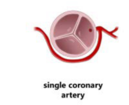 <p>The coronary arteries follow the anatomy of their respective morphologic ventricles, although a <strong>single coronary artery</strong> is common.</p>