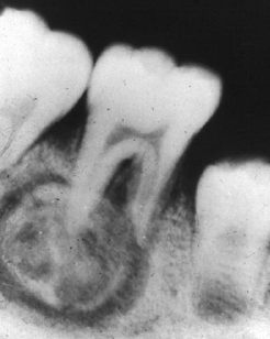 <p>RO mass that is fused to one or more tooth roots; outline of the root or roots is usually obscured; surrounded by a thin RL rim </p>