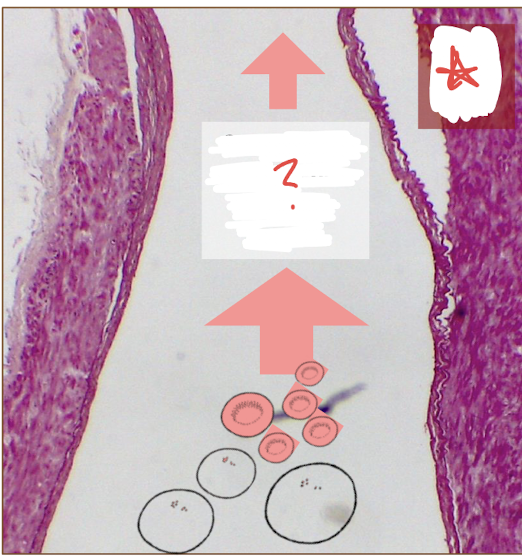 <p>Longitudinal section of diseased artery: What does the thicker artery well result in? </p>