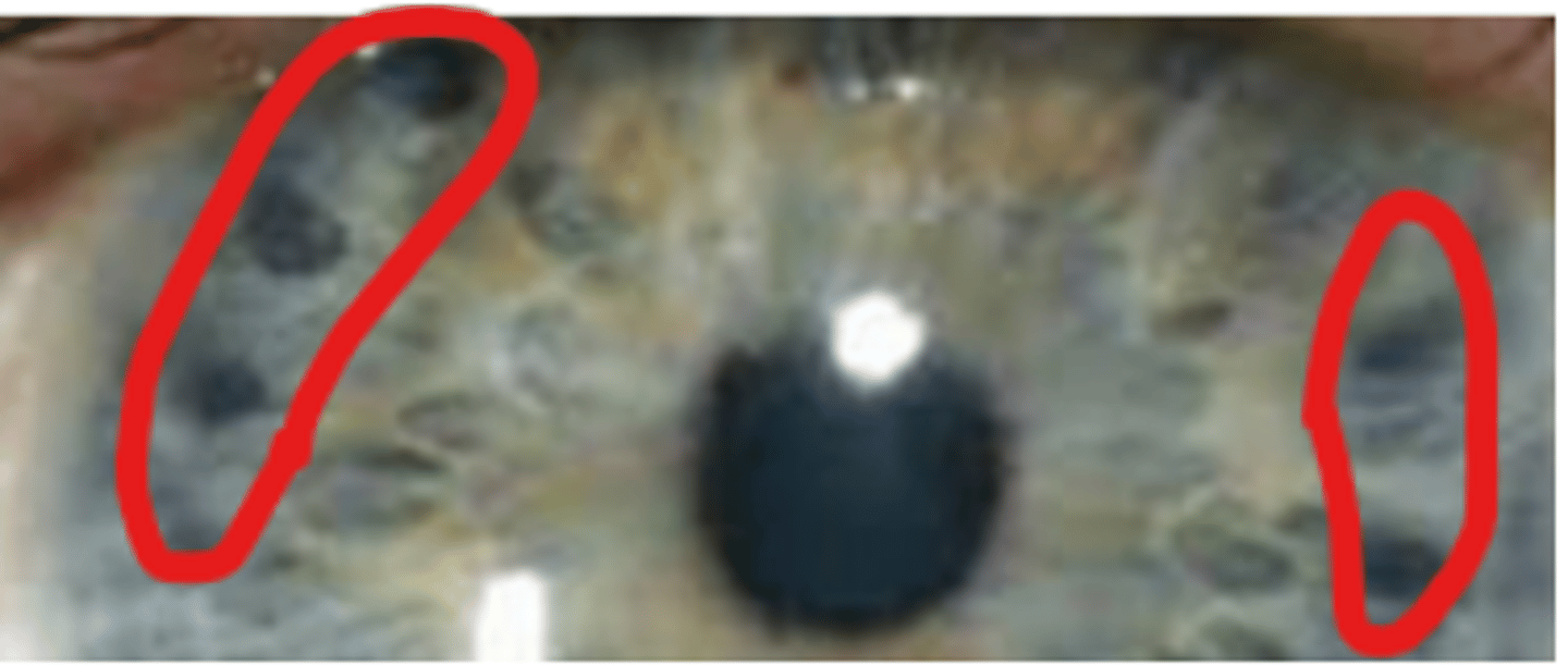 <p>procedure involving applying a series of laser burns of low power, long duration, and large size to the extreme peripheral iris. Scarring following laser treatment causes compaction of the iris stroma increasing the space between the anterior iris surface and the TM. Is typically used for PLATEAU IRIS, but can also be used to generally break an acute angle attack. LPI should still be performed in patients having pupil block.</p>