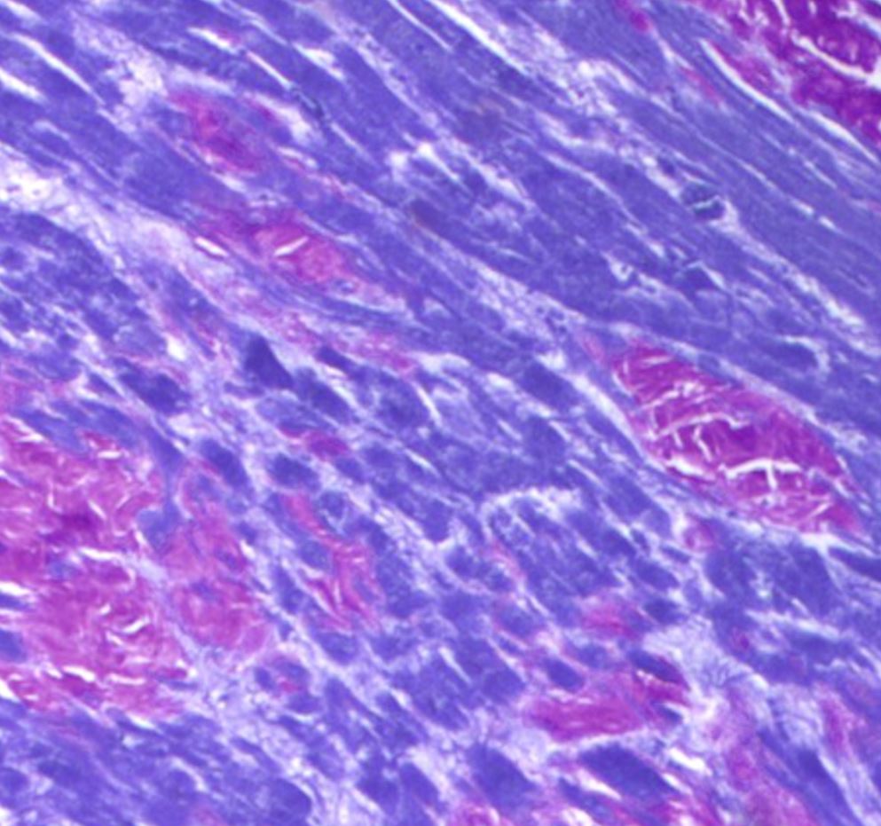 <p><em>National Society for Histotechnology. (2021). Crystal violet-stained amyloid tissue [Photomicrograph].</em></p>