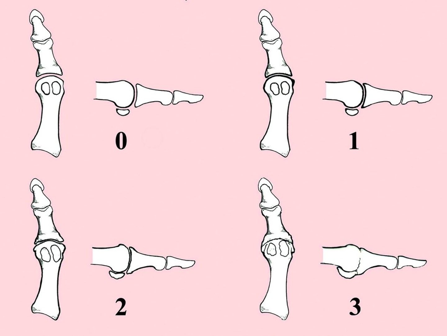 <p>Hallux Limitus Classification</p><p>Grade 1 - functional hallux limitus with dorsal spurring</p><p>Intact sesamoids with no associated disease</p><p>Joint enlargement but joint space narrowing and arthrosis</p><p><40° dorsiflexion and <20° plantarflexion</p><p>Grade 2 - broad flat metatarsal head with structural elevatus and significant spurring</p><p>Pain at rest</p><p>Osteochondral defects in metatarsal head and sesamoidal hypertrophy</p><p>Joint space hypertrophy and narrowing</p><p>75% decrease in total ROM</p><p>Grade 3 - ankylosis and articular hypertrophy with extensive peri-articular osteophytes</p><p>Osteochondral defect with joint mice and extensive 1st metatarsal-sesamoid disease</p><p>Severe loss of joint space or collapse of joint → bone on bone</p><p>FDL contracture</p>