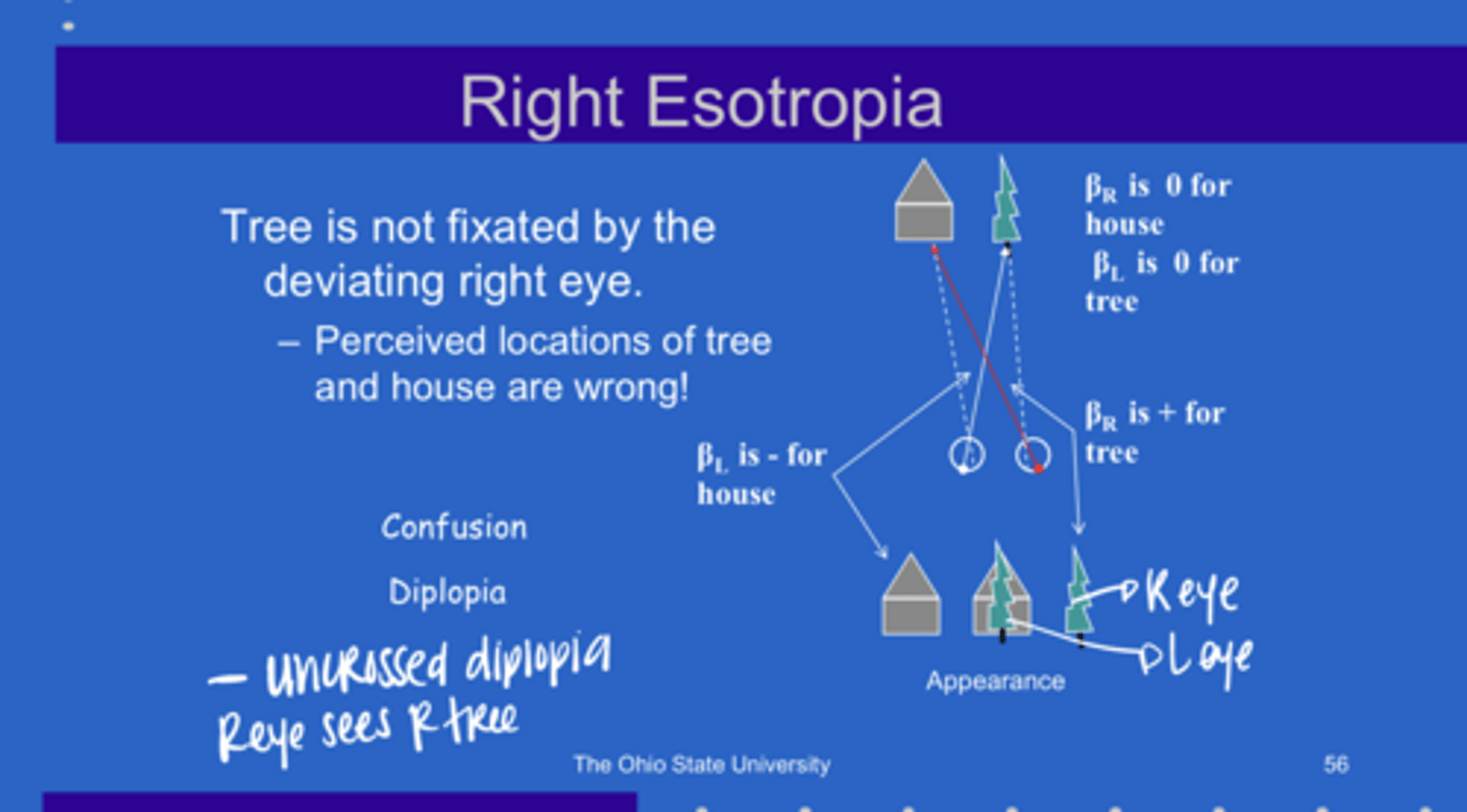 <p>When patient has a R esotropia, the ____ is not fixated by the deviating R eye</p>