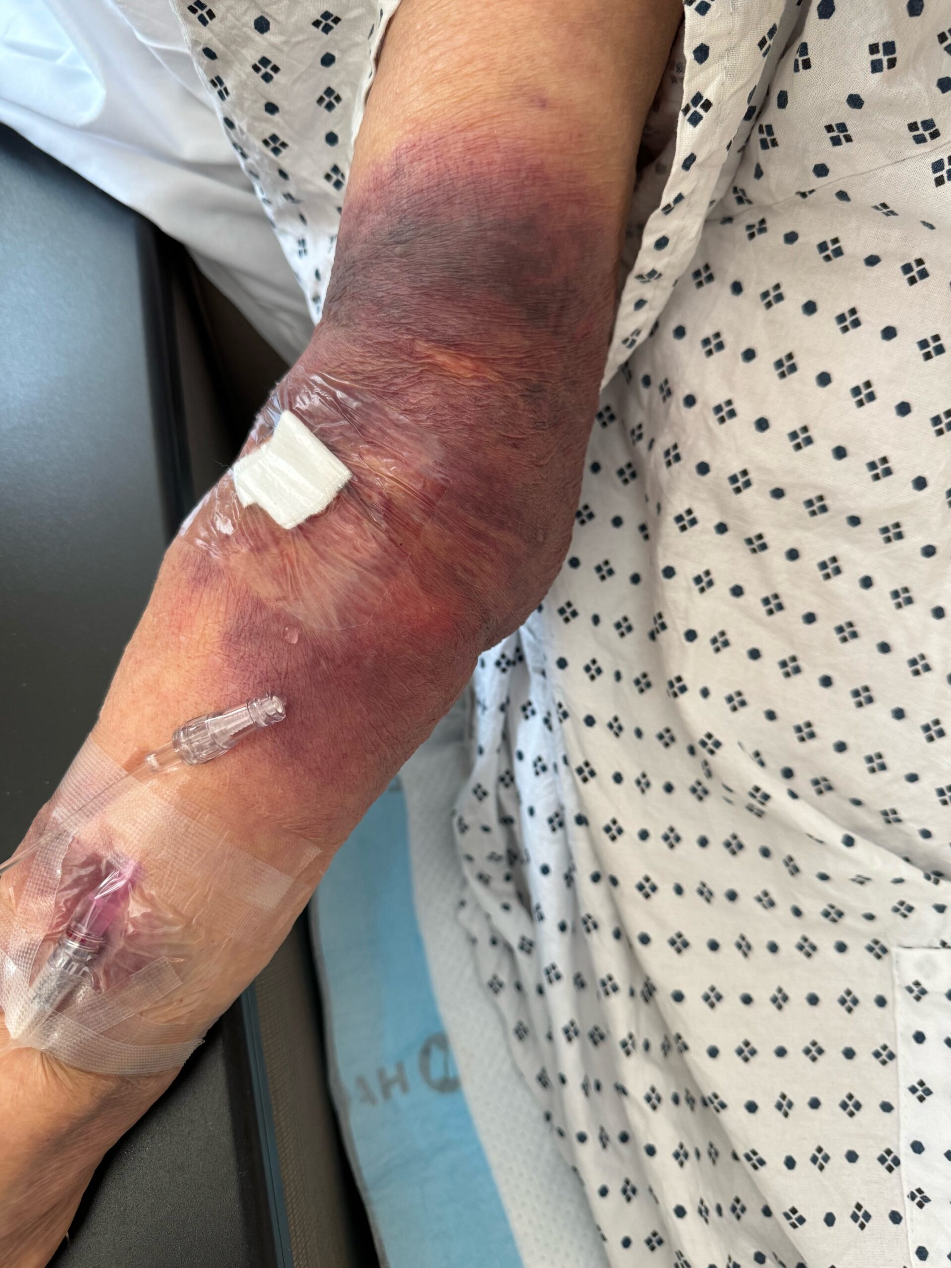 <p>S/S = swelling, discomfort, tightness. blanching, cool skin, decreased or stopped IV flow, <strong>SLOUGHING</strong></p><p></p><ul><li><p>STOP IV</p></li><li><p>Estimate how much went in (look @ bag + pump)</p></li><li><p>Administer antidote and MRHP contact</p></li><li><p>Elevate and assess frequently</p></li><li><p>Document</p></li></ul><p></p><p>Prevention: Use large veins!</p><p></p>