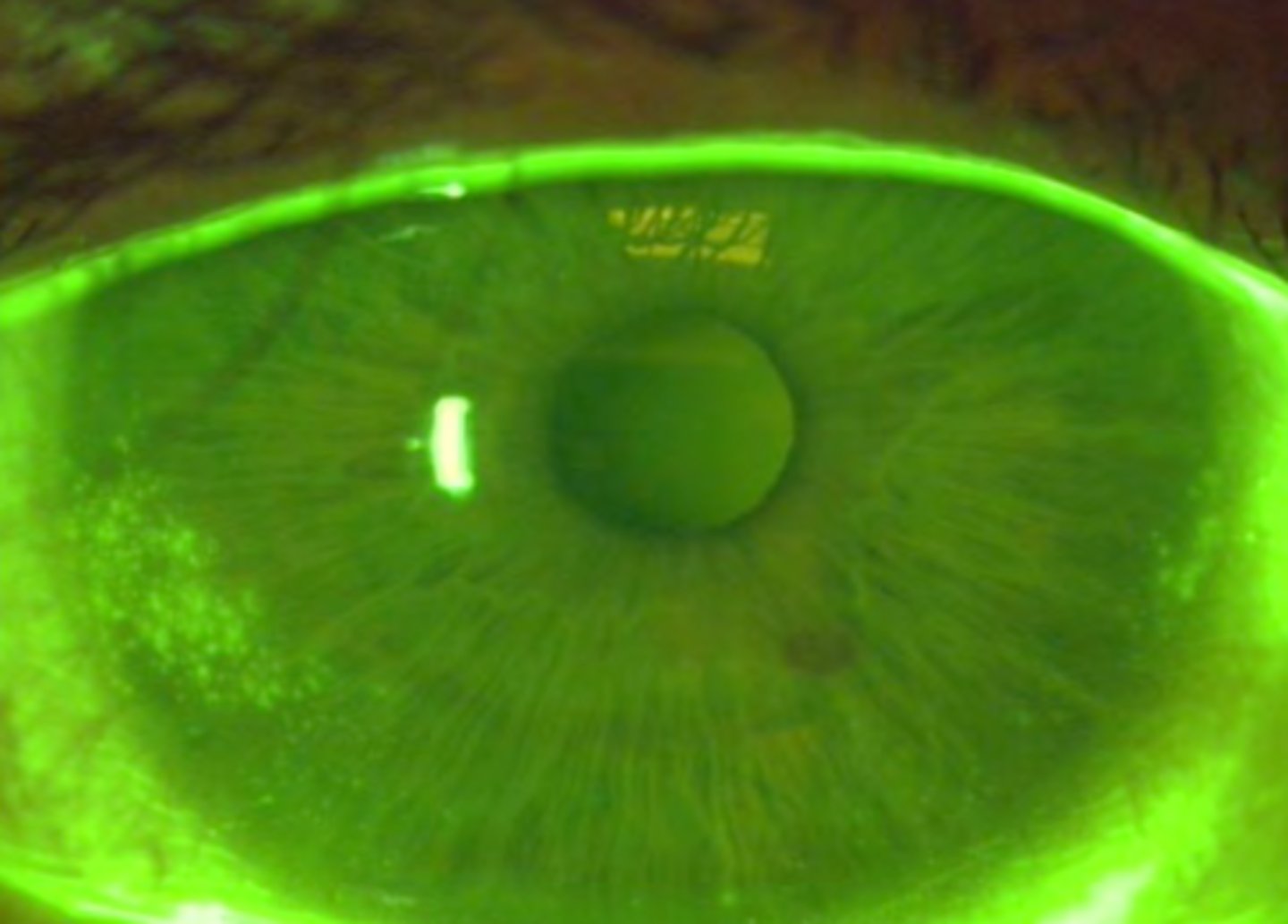 <p>presents parallel to the nasal and temporal limbus and is due to contact lens associated dry eye. Patients may experience mild discomfort.</p>