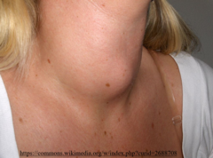 <p>goiter</p>