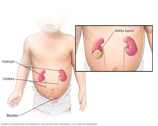 <ul><li><p>malignant tumor of the kidney (one/both)</p></li></ul><p></p>