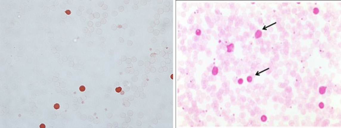<p>used to look for fetal cells in maternal blood (HDN), high HbF in <span style="background-color: transparent; font-family: "Noto Sans Symbols", sans-serif;">β</span><span style="background-color: transparent;">-thalassemias, evaluate response to hydroxuria in sickle cell patients. HbF inside RBCs will resist elution by weak acid (citrate). observe for fetal cells that counterstained due to retention of Hb F vs adult cells that did not counterstain due to elution of Hb A.</span></p>