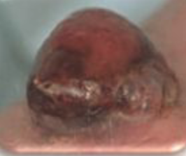 <p>nodule</p>