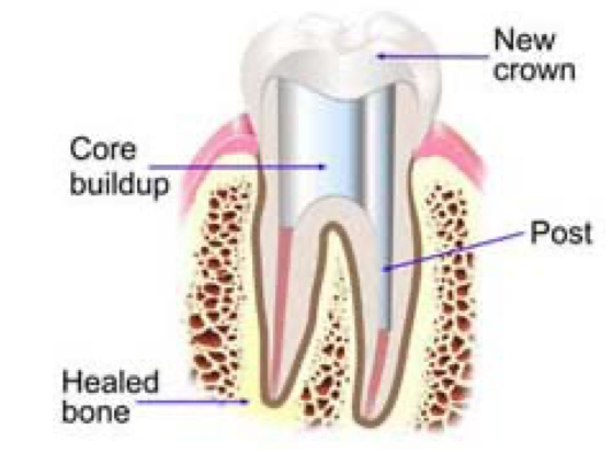 <p>core can be amalgam, glass ionomer cement, resin-based composite</p>